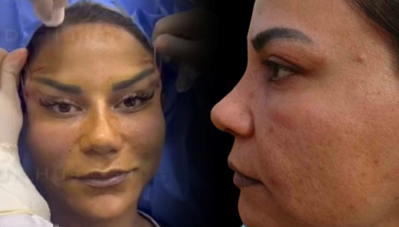 220 bin liraya estetik oldu hayati kabusa dondu PtP7HuX7