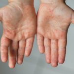 abdde salgin alarmi kizamiktan son 10 yilda ikinci mevt hAGcIIfy