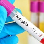 hemofili a hastalarina deri alti uygulanabilen ilac geri odeme kapsamina alindi iSNBDfvy