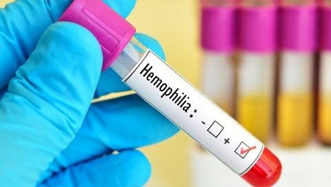 hemofili a hastalarina deri alti uygulanabilen ilac geri odeme kapsamina alindi iSNBDfvy