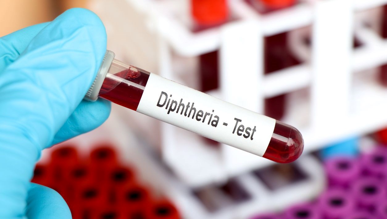 Nijerya'da Difteri Krizi: Ölüm Sayısı Bini Aştı 71 nijeryada difteri salgini mayis 2022den beri bin 319 kisi oldu Aj2Ll8W9