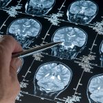 alzheimer babadan mi geciyor kanadali bilim insanlari acikladi OV6cLkhj