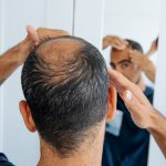 erkeklerde sac dokulmesinin en degerli 5 nedeni kel kalabilirsiniz ACHYzU5Y