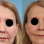 hastanelik eden zayiflama yontemi ozampik yuzu uyarisi Jm3m1tQZ