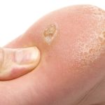 mantarin kokunu kurutuyor nasir egzama ve mantara 5 dakikada cozum tfuSARxW