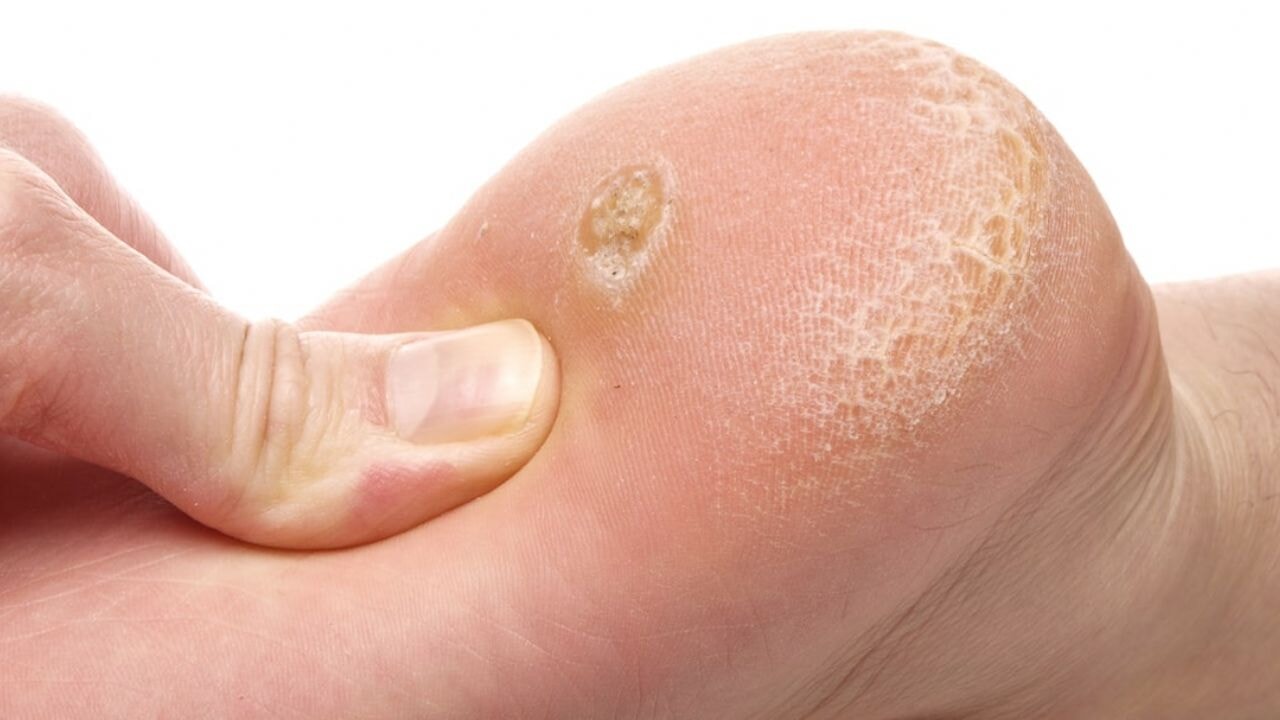 mantarin kokunu kurutuyor nasir egzama ve mantara 5 dakikada cozum