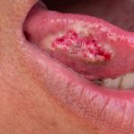 migren agrisi 4 evre kanser cikti lisaninin yuzde 80i alindi 36 yasindaki bayanin onemsemedigi iu4mYASL