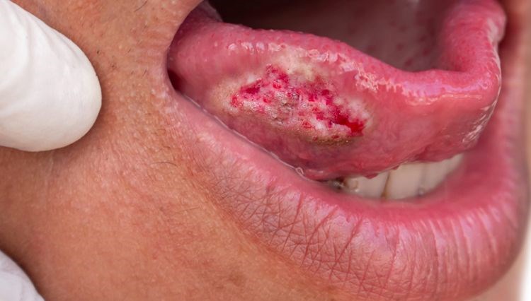 migren agrisi 4 evre kanser cikti lisaninin yuzde 80i alindi 36 yasindaki bayanin onemsemedigi iu4mYASL