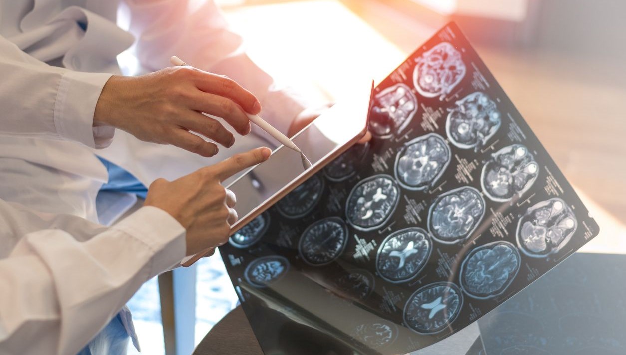 noroloji uzmani uyariyor agir covid 19 gecirenler risk altinda dzPPI1fL