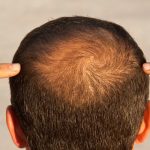 sac dokulmesini aninda durdurabilecek 5 aliskanlik ecKiGuMg