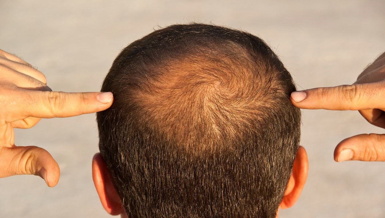 sac dokulmesini aninda durdurabilecek 5 aliskanlik ecKiGuMg