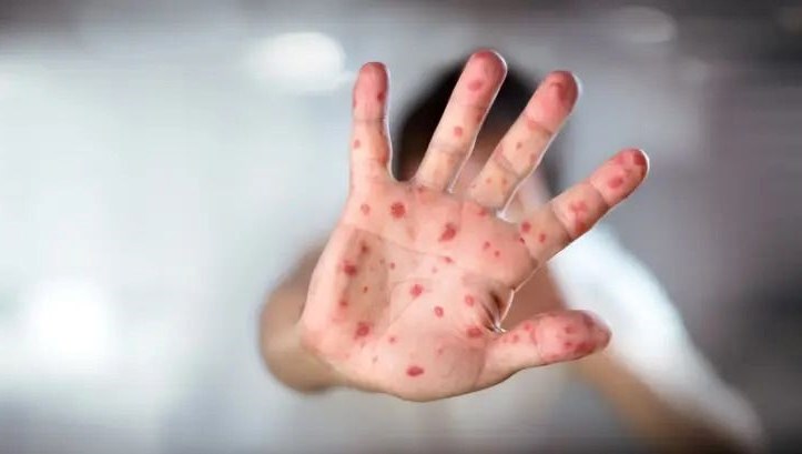 salgin tehlikesi buyuyor kizamik hadiseleri 500e ulasti