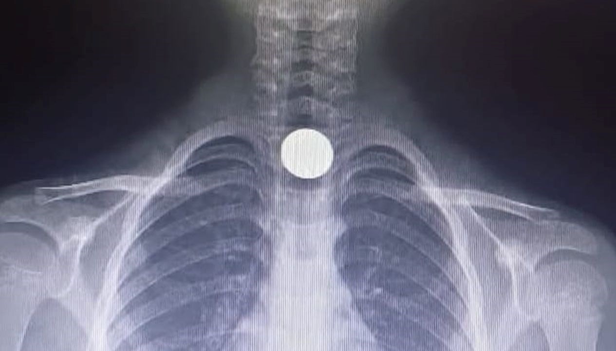 Yemek Borusunda Madeni Para Kabusu: Ameliyatla Son Bulan Tehlikeli An 71 yemek borusuna takilan madeni para operasyonla cikarildi 5yeu6SgR
