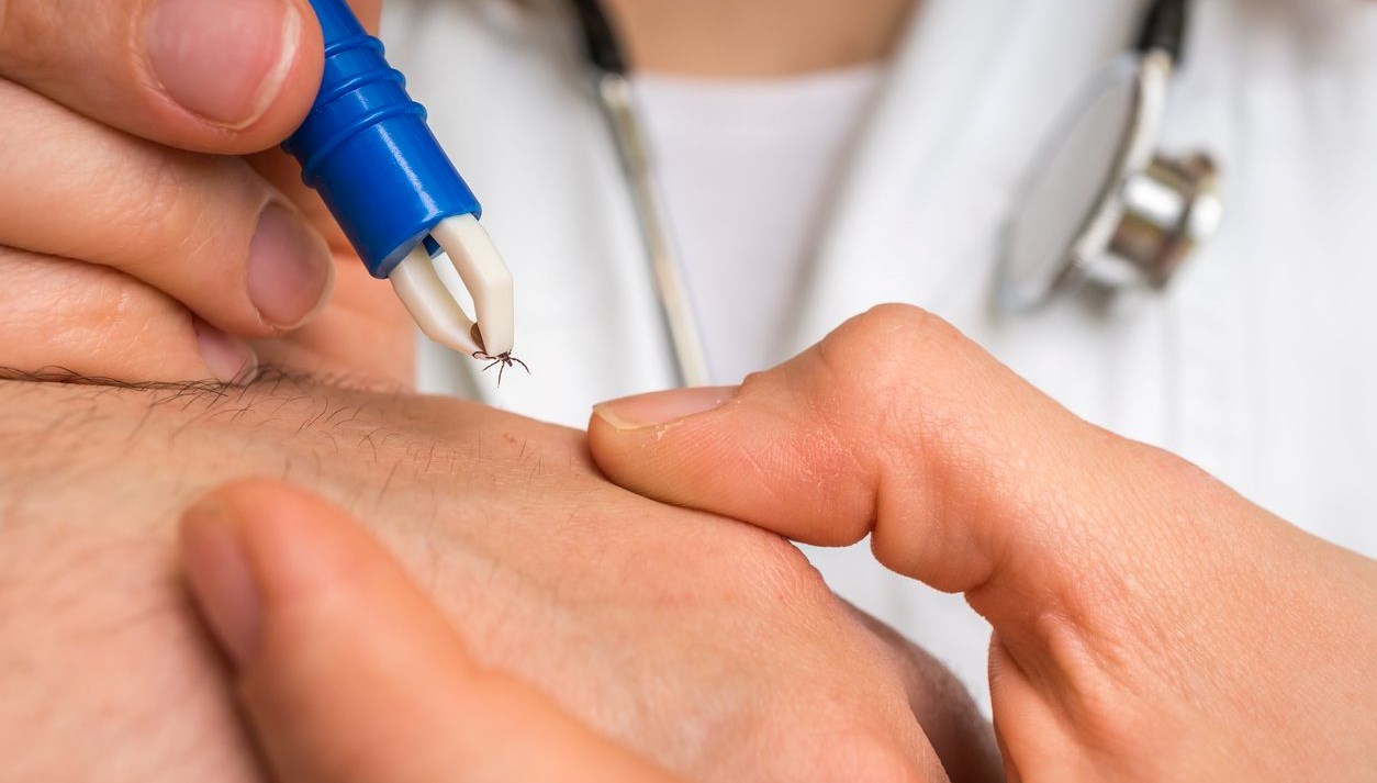 2 çocuk annesi bayan hayatını kaybetti: Kene ısırırsa sakın bunu yapmayın 71 2 cocuk annesi bayan hayatini kaybetti kene isirirsa sakin bunu yapmayin 3KGZev8U