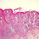 cinsiyete gore vucuda yayilan kanser melanom uurUd4bt