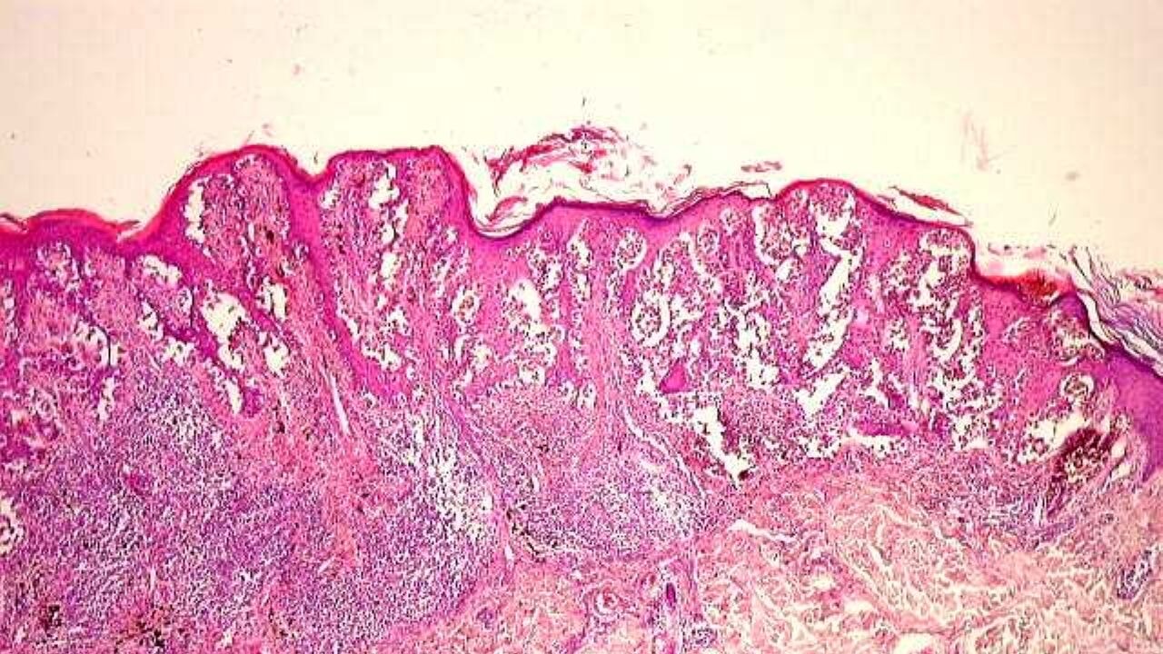 cinsiyete gore vucuda yayilan kanser melanom uurUd4bt