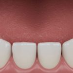 dis yuzeyindeki puturler neden olusur nasil giderilir uzmanlarin onerisi tirtikli disler icin ne yapilir mD4AIAsp