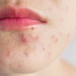 sivilceye karsi asi yolda VTN8hlbe