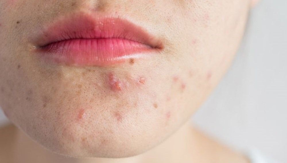 sivilceye karsi asi yolda VTN8hlbe