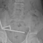 200 miknatis yuttu bagirsaklarini kaybetti temudan aciklama b2b3KMMQ