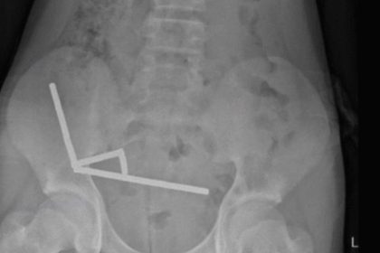 200 miknatis yuttu bagirsaklarini kaybetti temudan aciklama b2b3KMMQ