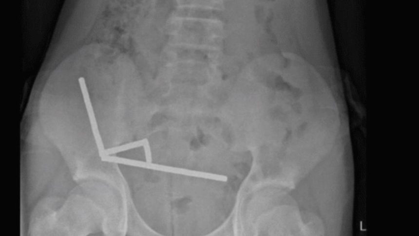 200 miknatis yuttu bagirsaklarini kaybetti temudan aciklama b2b3KMMQ