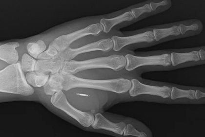 bedenine yerlestirdigi cipin sifresini unuttu nZ3Ypb5A